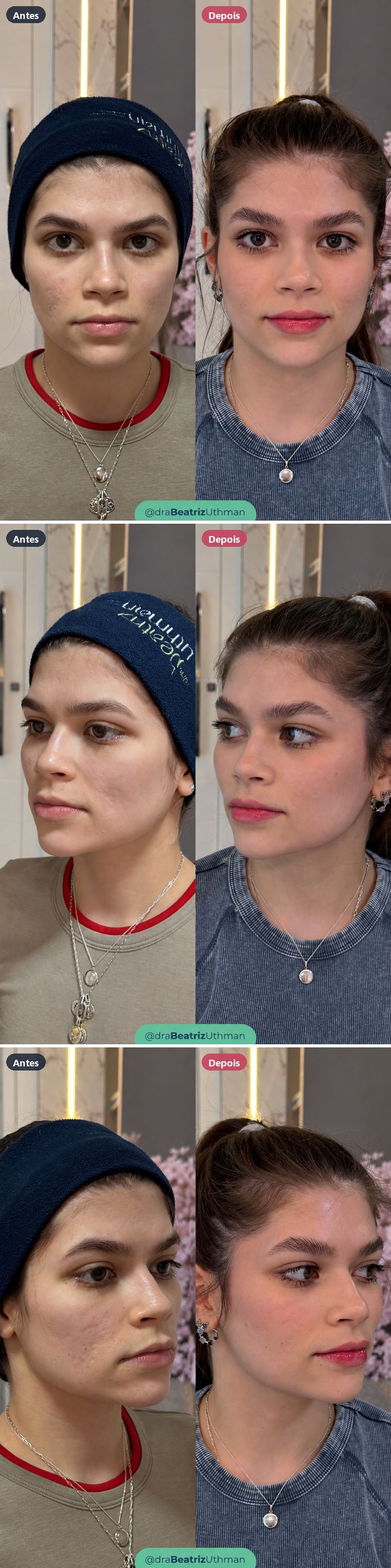 Cicatrizes de acne · Caso 2: antes e depois