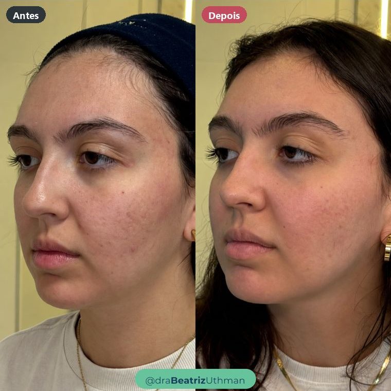 Cicatrizes de acne · Caso 3: antes e depois