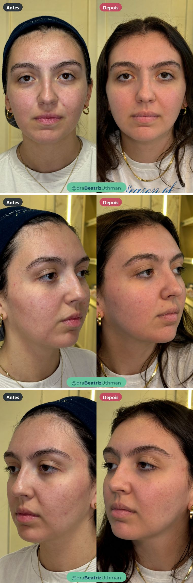 Cicatrizes de acne · Caso 3: antes e depois