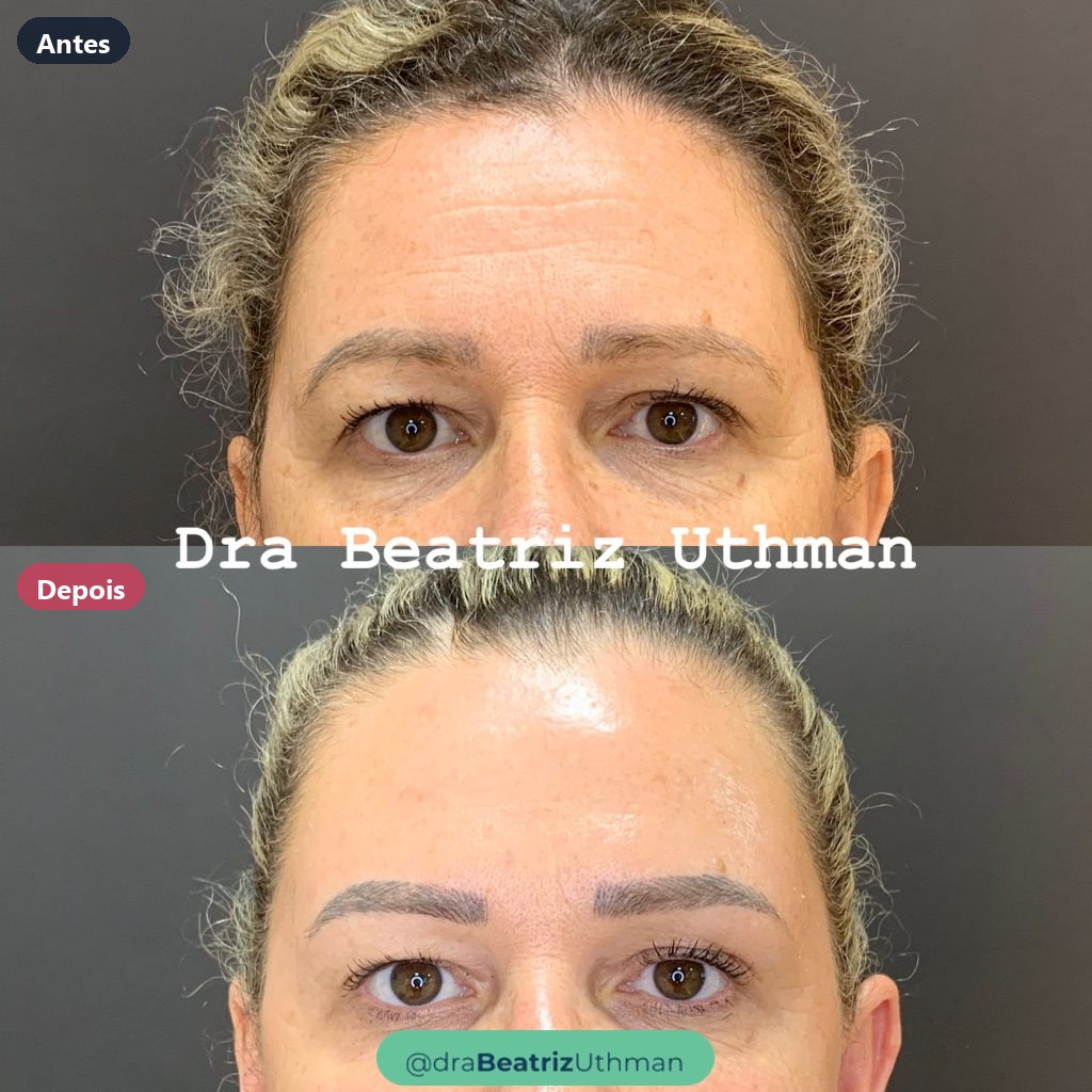 Caso 9 com toxina botulínica: antes e depois