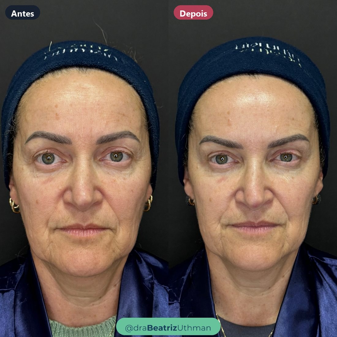 Caso 1 com toxina botulínica: antes e depois
