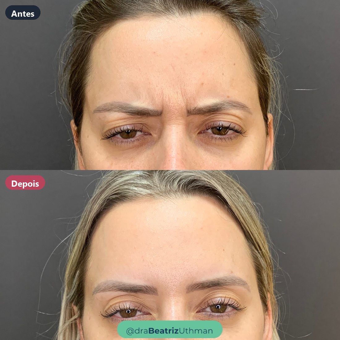 Caso 4 com toxina botulínica: antes e depois