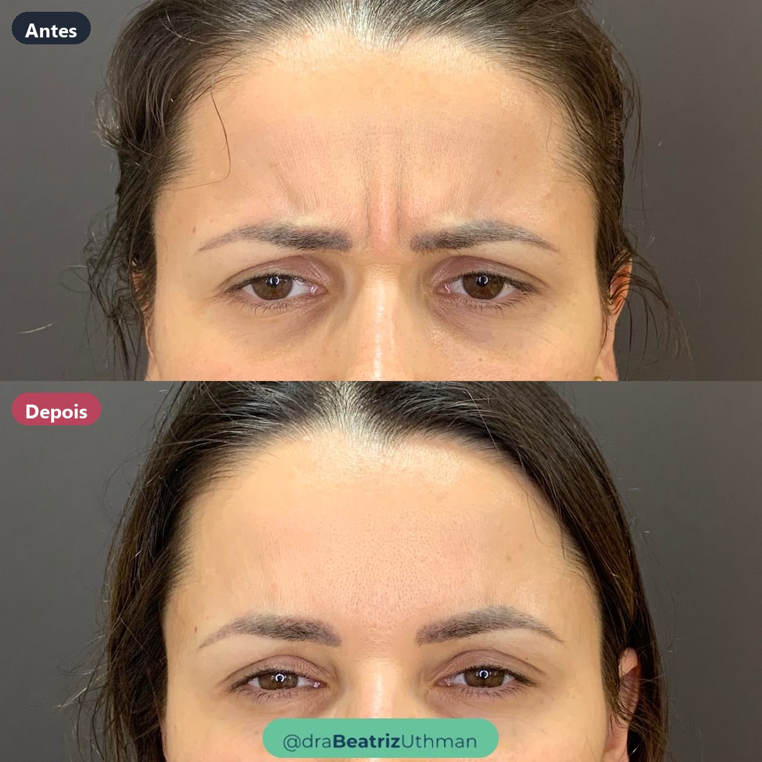 Caso 6 com toxina botulínica: antes e depois