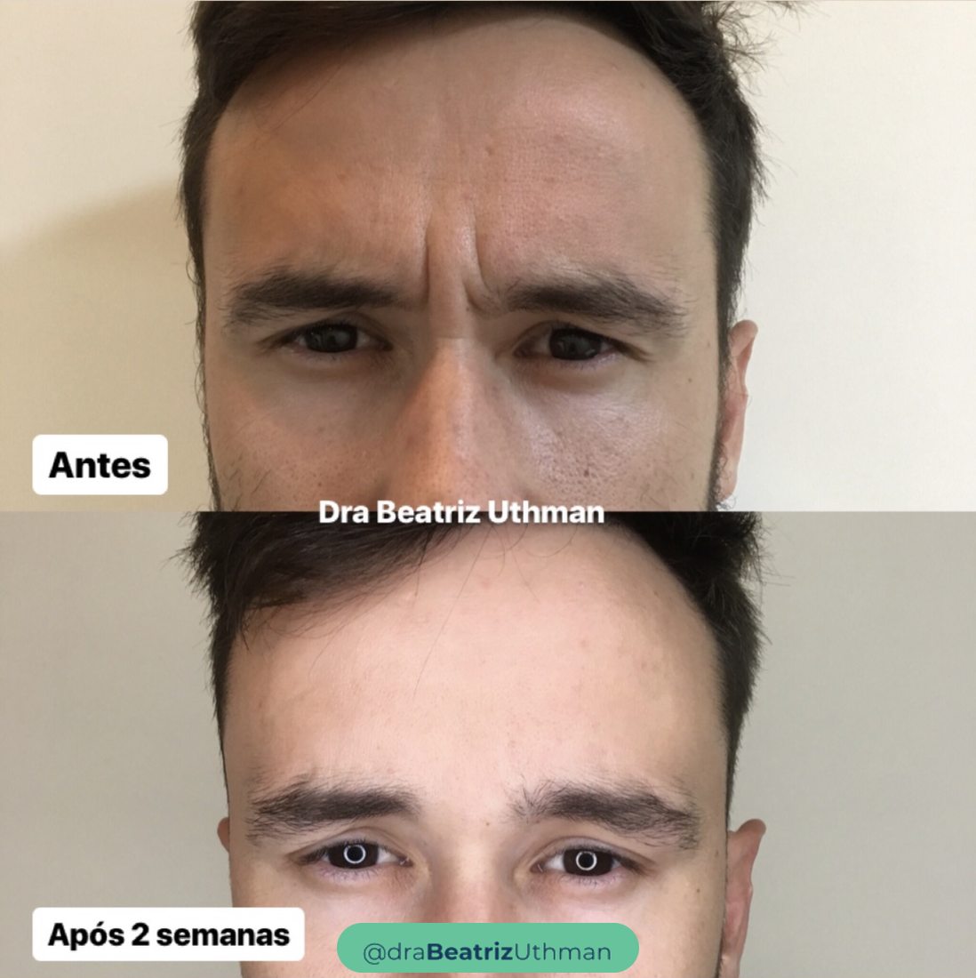 Caso 8 com toxina botulínica: antes e depois