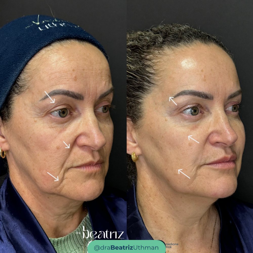 Caso 2 com Ultraformer: antes e depois