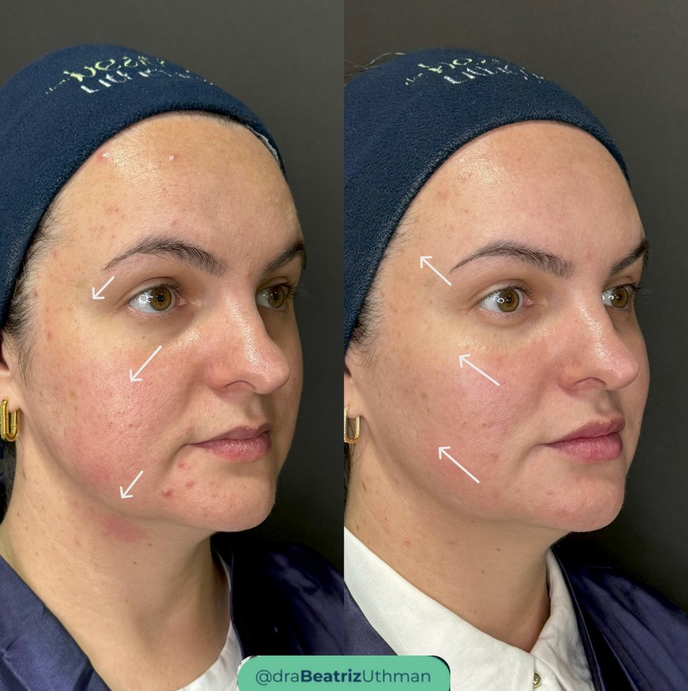 Caso 3 com Ultraformer: antes e depois