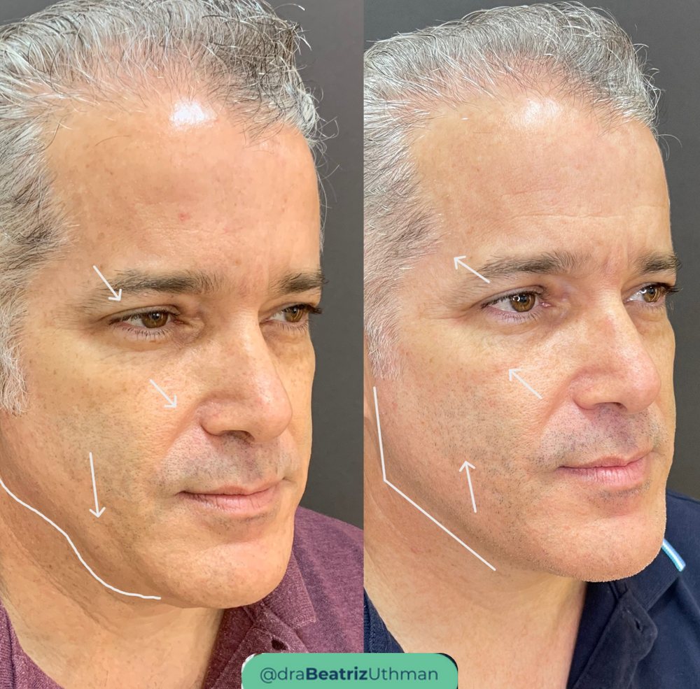 Caso 4 com Ultraformer: antes e depois