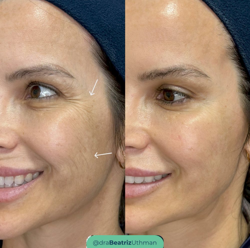 Caso 5 com Ultraformer: antes e depois