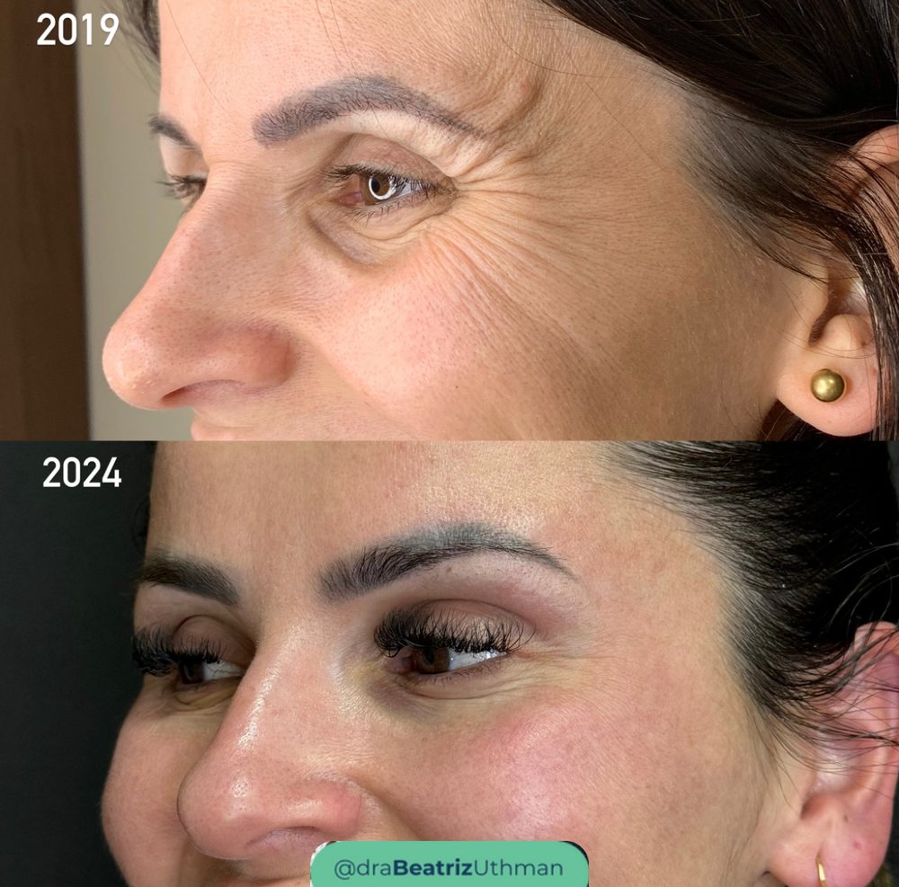 Caso 6 com Ultraformer: antes e depois